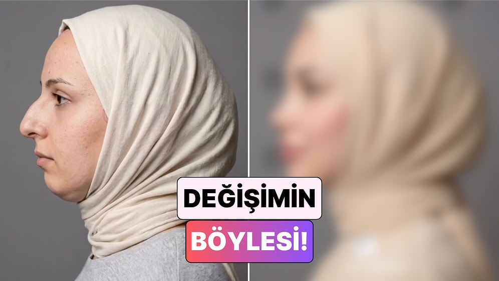 Bambaşka Biri Oldu: Bir Kadın Yaptırdığı Estetiklerle Yaşadığı Değişimi Paylaştı
