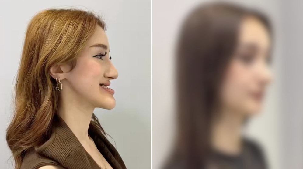 Stunning Transformation: Woman Earns Praise Online After Jaw Surgery