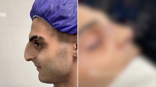Broken Four Times: Fighter Shares Incredible Nose Transformation After Surgery