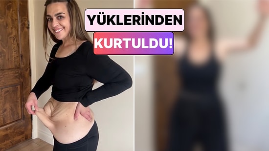 Kilo Verdikten Sonra Deri Sarkması Problemi Yaşayan Kadın Geçirdiği Ameliyatların Ardından Değişimini Paylaştı