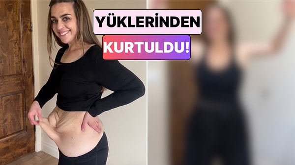 Kilo Verdikten Sonra Deri Sarkması Problemi Yaşayan Kadın Geçirdiği Ameliyatların Ardından Değişimini Paylaştı