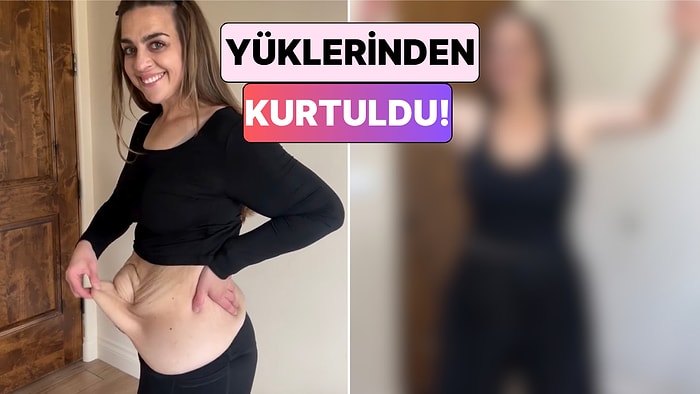 Kilo Verdikten Sonra Deri Sarkması Problemi Yaşayan Kadın Geçirdiği Ameliyatların Ardından Değişimini Paylaştı