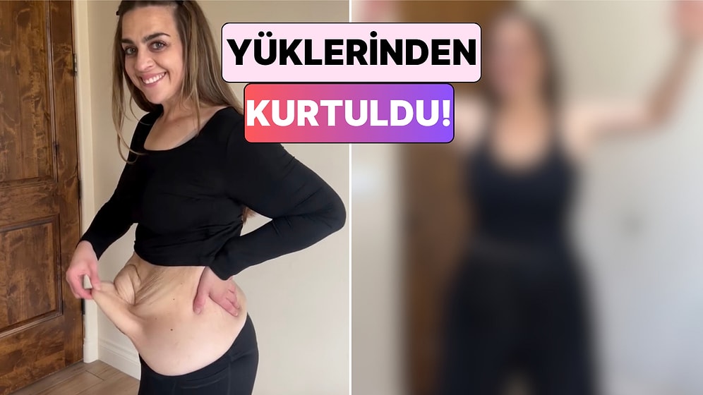 Kilo Verdikten Sonra Deri Sarkması Problemi Yaşayan Kadın Geçirdiği Ameliyatların Ardından Değişimini Paylaştı