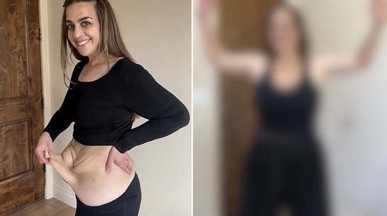 Unbelievable Transformation: Woman Shares Skin Removal Surgery After Weight Loss