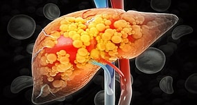 Top Food to Prevent Fatty Liver Revealed as Experts Suggest Daily Olive Oil Use