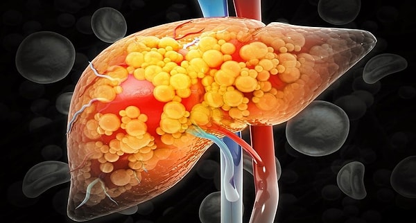 The food most emphasized by experts in the treatment of fatty liver disease is not a fruit or vegetable: it's extra virgin olive oil.
