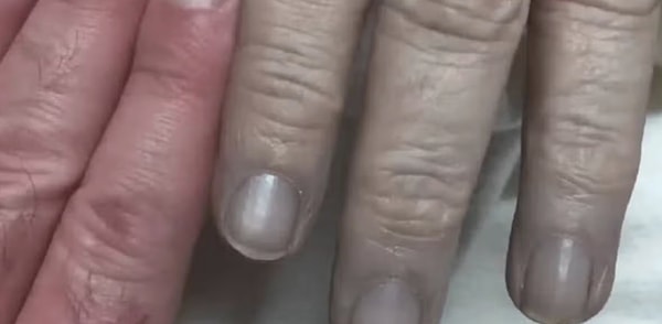 Dr. Cawein implemented a surprising method to turn patients' skin pink: injecting methylene blue into the body.