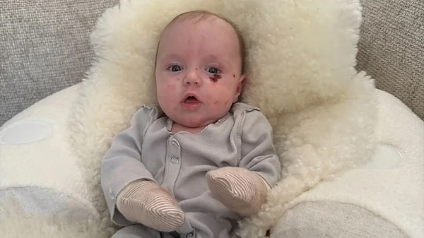 İngiltere'de yaşayan Ciara Burnside, dünyaya geldikten kısa süre sonra vücudunda yaralar ve su toplamaları oluşan bebeğinin nadir bir genetik hastalığa sahip olduğunu öğrendi.