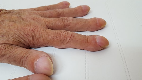 Parmak Uçları Şişip Tırnak Aşağı Kıvrılıyorsa Doktora Gidilmeli
