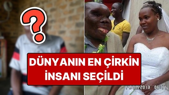 'Dünyanın En Çirkin İnsanı': Kasları Yavaş Yavaş Kemiğe Dönüşen Baguma'nın Hikâyesi
