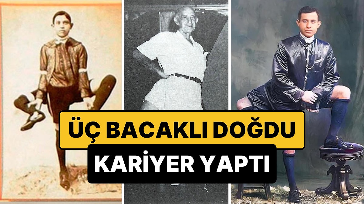 Üç Bacak, Dört Ayak ve On Altı Parmak: 1900'lerdeki Sirklerin Aranan İsmi, Frank Lentini