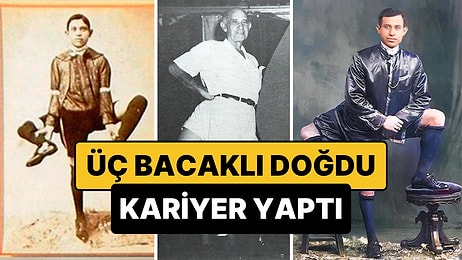 Üç Bacak, Dört Ayak ve On Altı Parmak: 1900'lerdeki Sirklerin Aranan İsmi, Frank Lentini