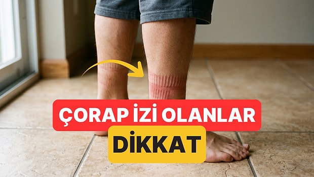Çorapların Bacaklarınızda İz Bırakması Ne Anlama Geliyor?
