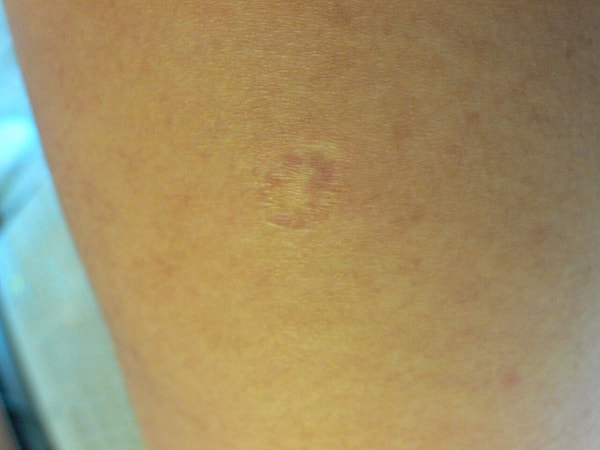 Why Did Childhood Vaccines Leave a Round Scar on Our Left Arm?