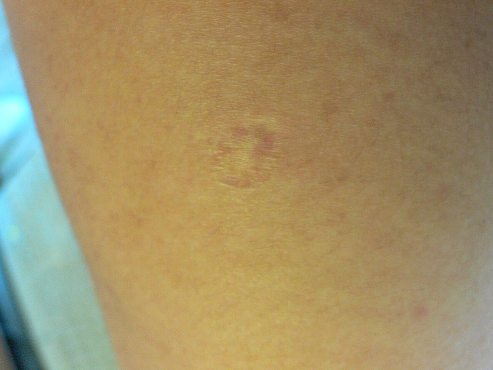 Why Did Childhood Vaccines Leave a Round Scar on Our Left Arm?