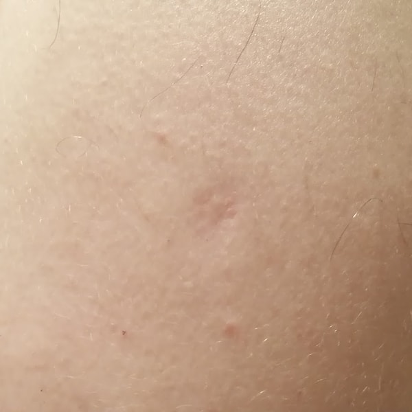 The reason for the permanence of the permission is that, unlike many other vaccines, this vaccine is administered directly into the skin.