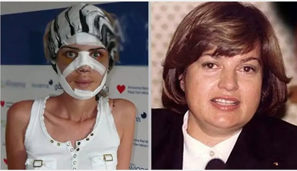Çiğdem Savaş, Tansu Çiller'e benzemek uğruna 2008 yılında tam 7 saat süren bir estetik operasyon için ameliyat masasına yattı.