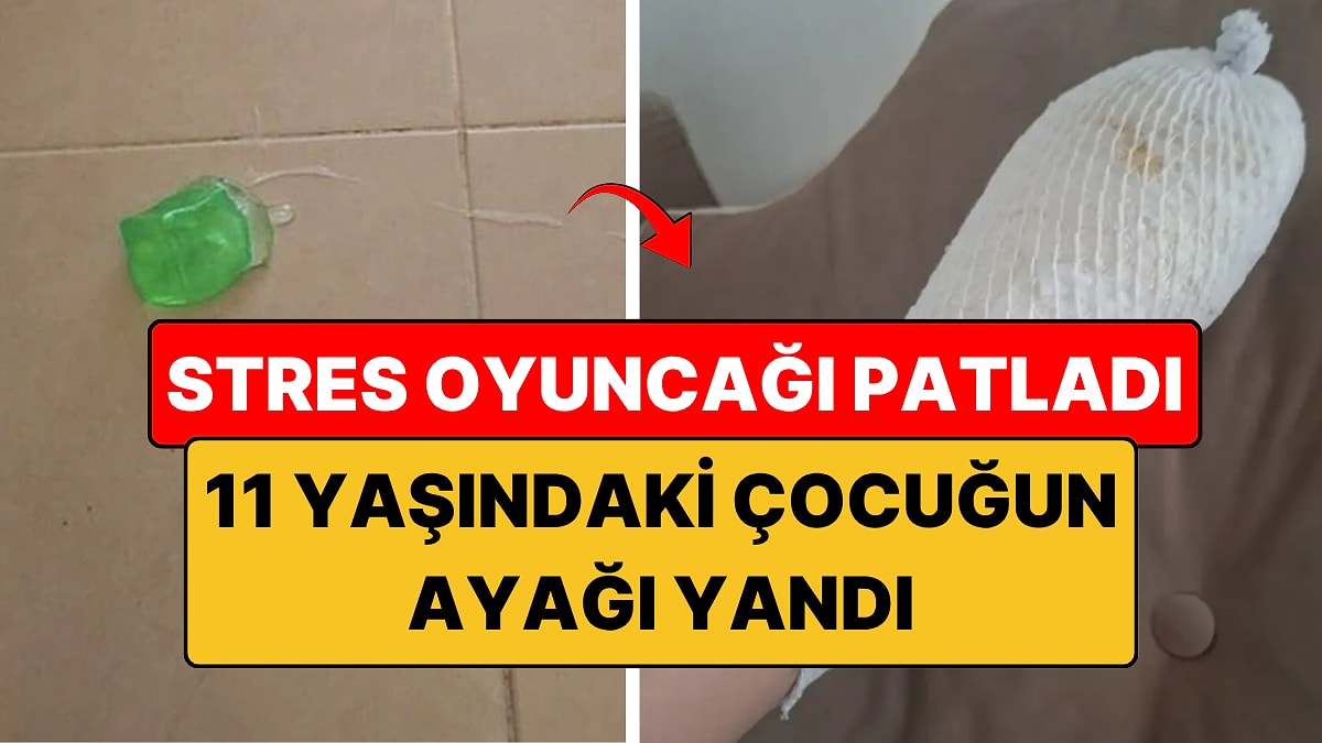 Stres Oyuncağı Patladı: 11 Yaşındaki Çocuğun Ayağında 2. Derece Yanık Oluştu