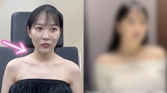 South Korea's Latest Cosmetic Surgery Trend: Shoulder Broadening Operations