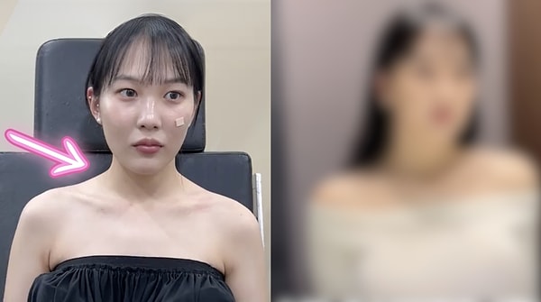 South Korea's Latest Cosmetic Surgery Trend: Shoulder Broadening Operations