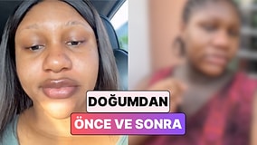 Bir Kadın Hamilelik Sırasında Yüzünde Meydana Gelen Değişimi Paylaştı