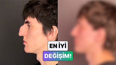 Bir Cerrah Çocukken Burnuna Darbe Alan Gencin Rinoplasti Sonrası Değişimini Paylaştı