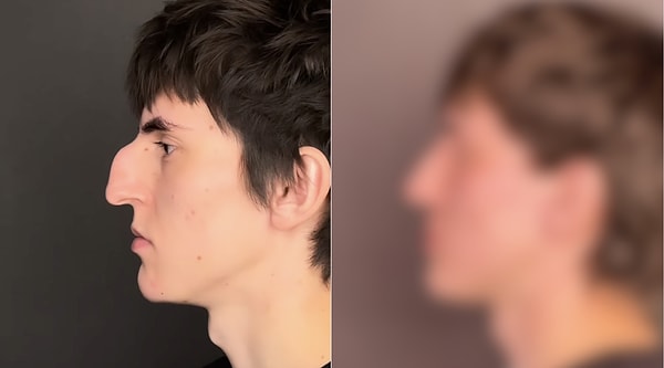 Stunning Nose Transformation After Childhood Injury!