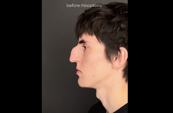 So, how is closed rhinoplasty performed?