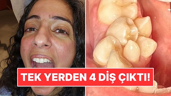 Tek Dişin Çıkması Gereken Yerden 4 Diş Çıktı