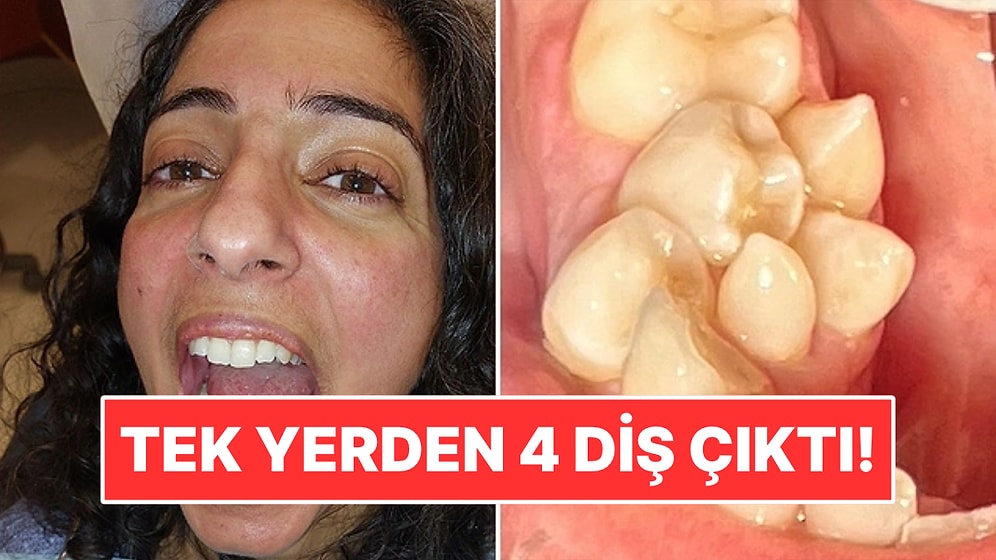Tek Dişin Çıkması Gereken Yerden 4 Diş Çıktı