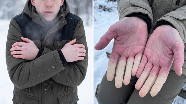 Cold Temperatures and Raynaud’s Phenomenon