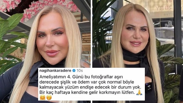 Yeni görüntülerinin gündeme gelmesinin ardından sosyal medya hesabından açıklama yapan Nagihan Karadere, yüzündeki şişliklere ilişkin endişelere yanıt verdi.