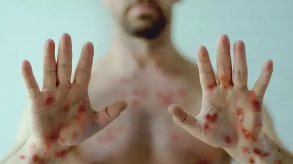 Afrika'da ortaya çıkan maymun çiçeği (mpox) virüsü dünyada bir kez daha pandemi korkusu yaratmış durumda.