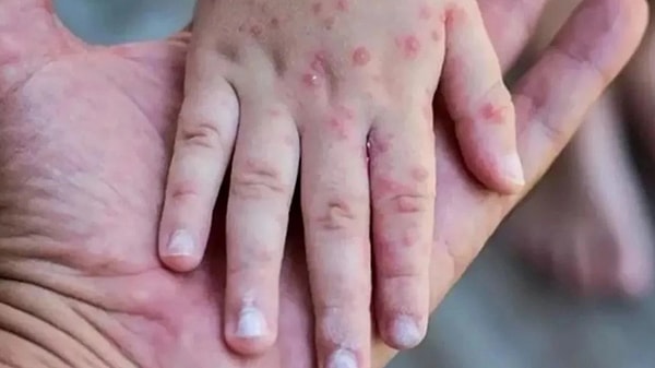 Hastalıktan korunma yöntemlerine dair de bilgi veren Güner, bulaştırıcılıkta yakın temas ile uzun süreli yakın temasın ön plana çıktığını belirtti. Güner şunları söyledi: 👇